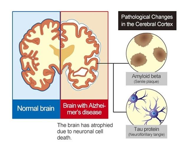 Normal brain and brain with alzheimers