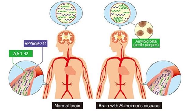 normal brain and alzheimers brain