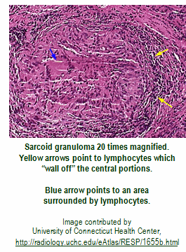 sarcoid granuloma