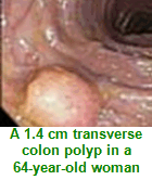 polyp1